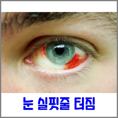 눈 하단부에 실핏줄이 터져 빨갛게 출혈이 나타난 사진이다