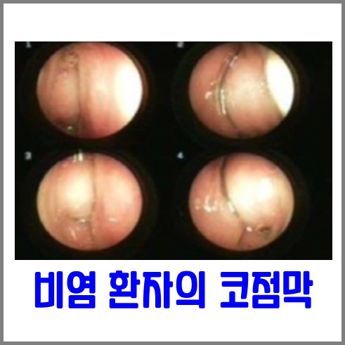 알레르기 비염 환자의 코 점막 내시경 사진