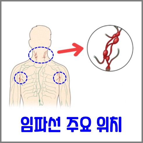 임파선의 주요 위치는 목과 겨드랑이다