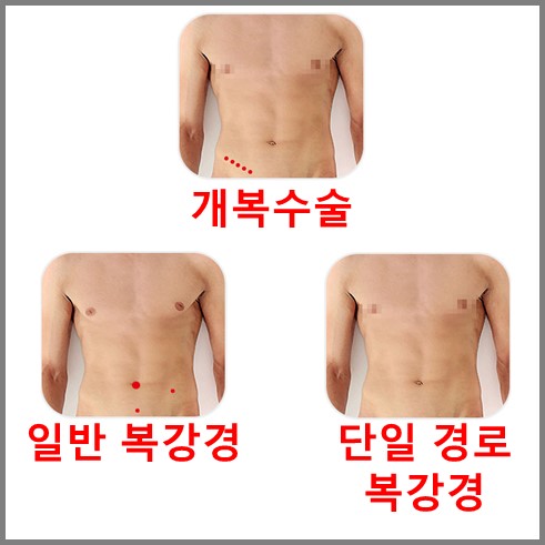 맹장수술의 종류 설명, 종류에 따라 맹장수술 입원기간 차이가 난다