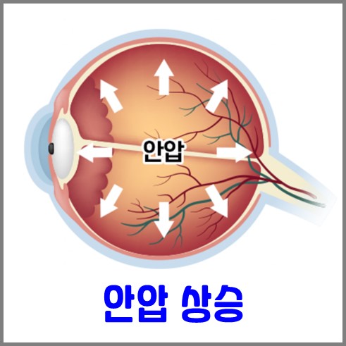 눈 실핏줄 터짐 원인 중 하나인 안압 상승 그림