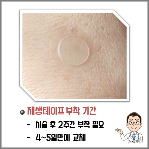 점빼고 재생테이프 부착기간은 2주고 4~5일만에 교체 표시 그림