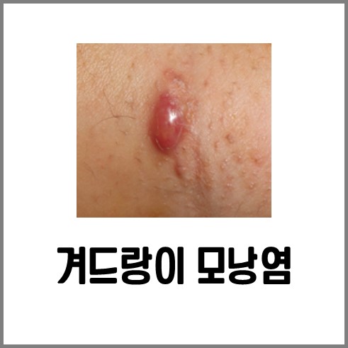 켜털 뽑으면 생긴 모낭염