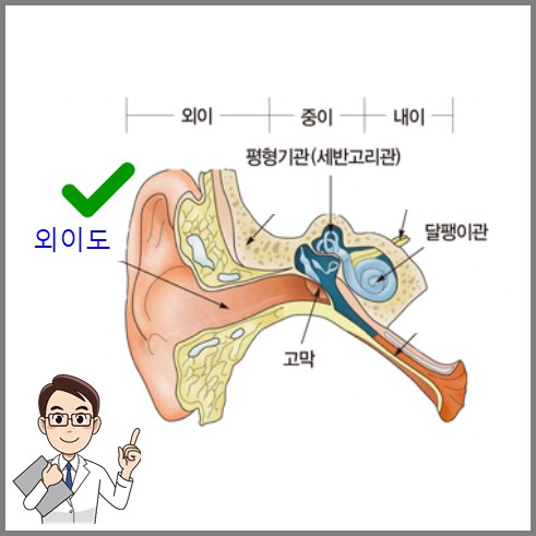 귀의 내부 구조로 외이도 염을 표시한 사진