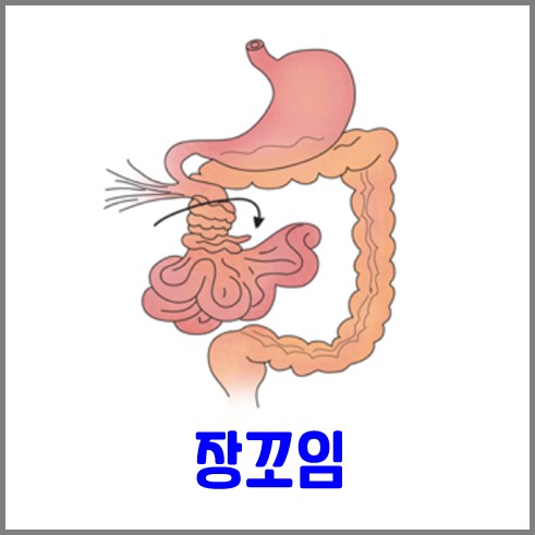 장꼬임 증상 : 꼬여있는 장 그림