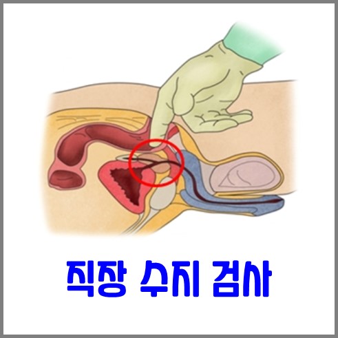 손가락으로 항문 안쪽을 검사하는 직장 수지 검사 방법