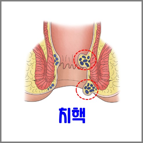 치핵은 위치에 따라 내치핵과 위치핵이 있다