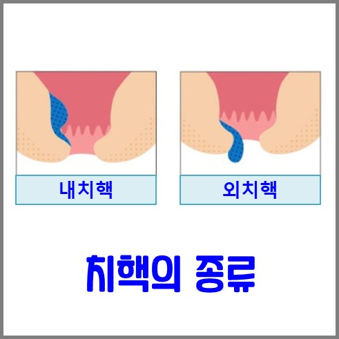 치핵의 종류로 안쪽에 있는 내치핵, 바깥쪽에 있는 외치핵이 있다