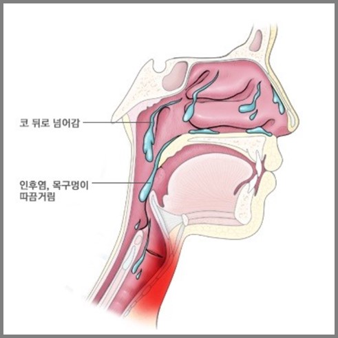 후비루 증후군 설명 사진
