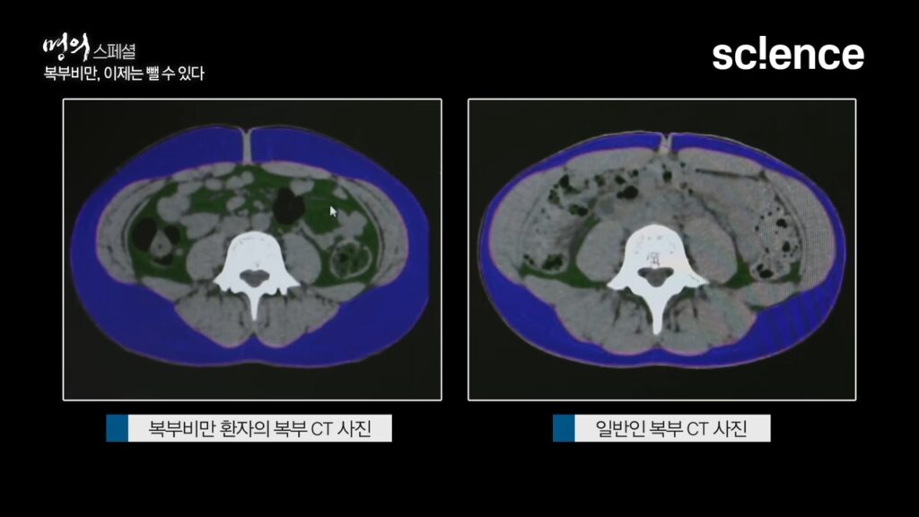 내장 지방 레벨 기준 : 복부비만 환자의 CT사진과 일반인 복부 CT사진 비교