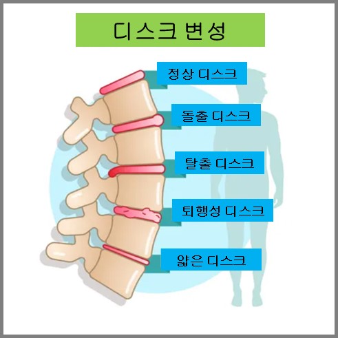 디스크의 변성 모습으로 정상, 돌출, 탈출, 퇴행성, 얇은 디스크가 있다