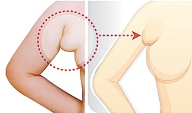 출산후 겨드랑이 멍울 원인 : 부유방 그림