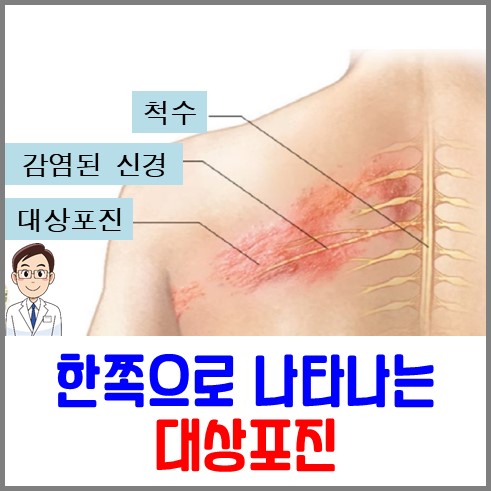 대상포진 초기증상 한쪽으로 나타나는 대상푀진의 발진