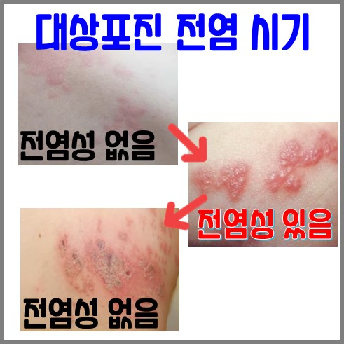 대상포진 전염 시기 설명