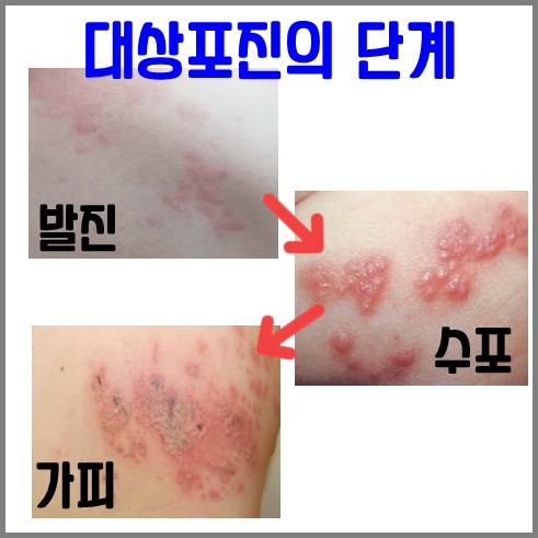 대상포진의 단계