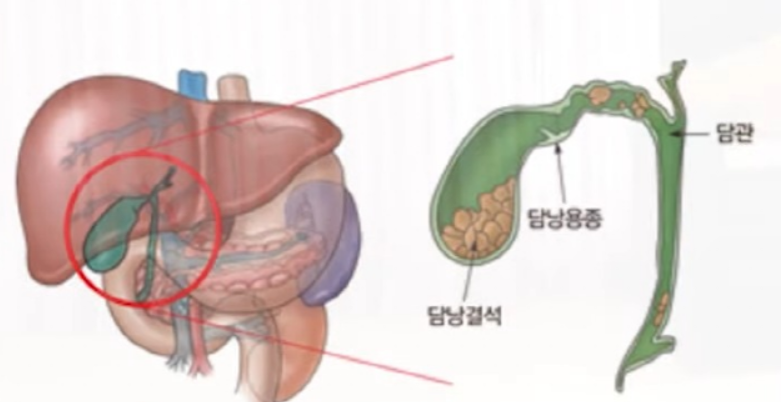 담낭 결석