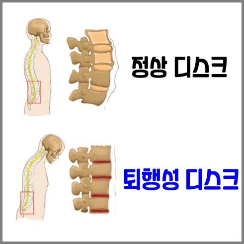 정상 허리디스크와 퇴행성 허리디스크의 비교