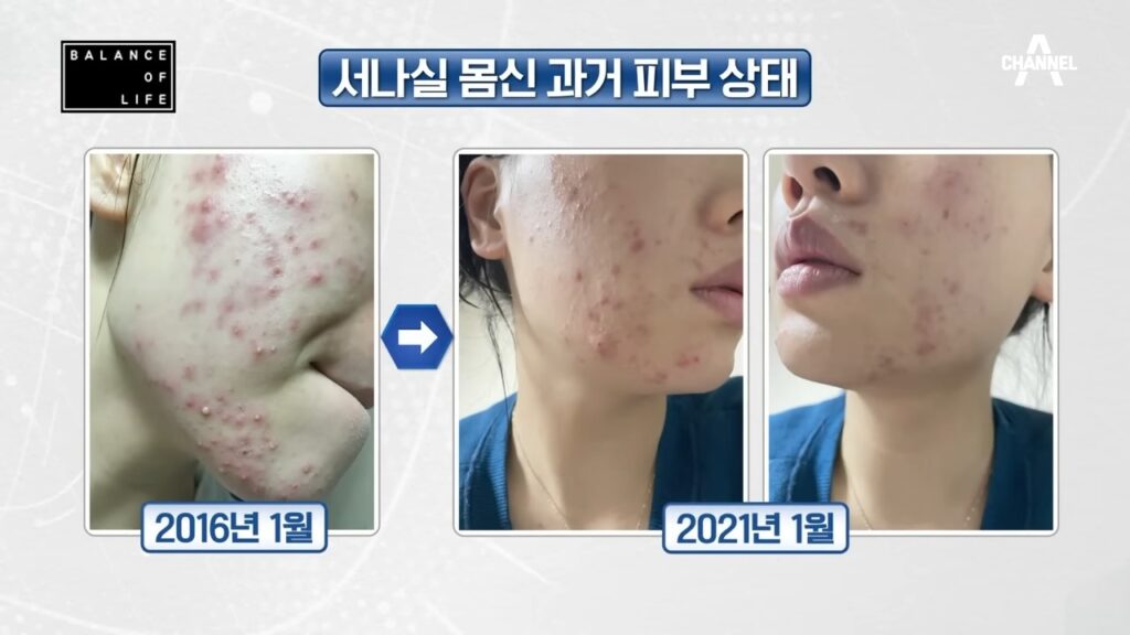 나는 몸신이다 돌고래팩 사용전 주인공 얼굴 피부로 여드름이 많다