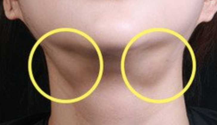 먹토 얼굴형 변형 : 침샘비대증