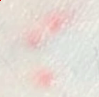 권연벌레 물린 자국