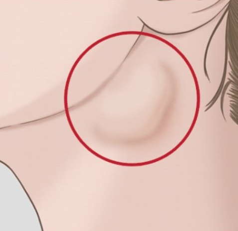 턱아래 멍울 원인 : 침샘종양