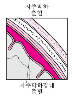 지주막하 출혈